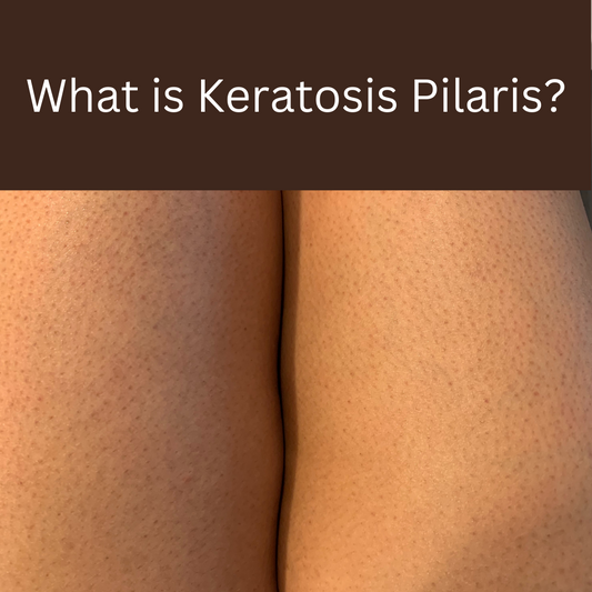 What is Keratosis Pilaris?